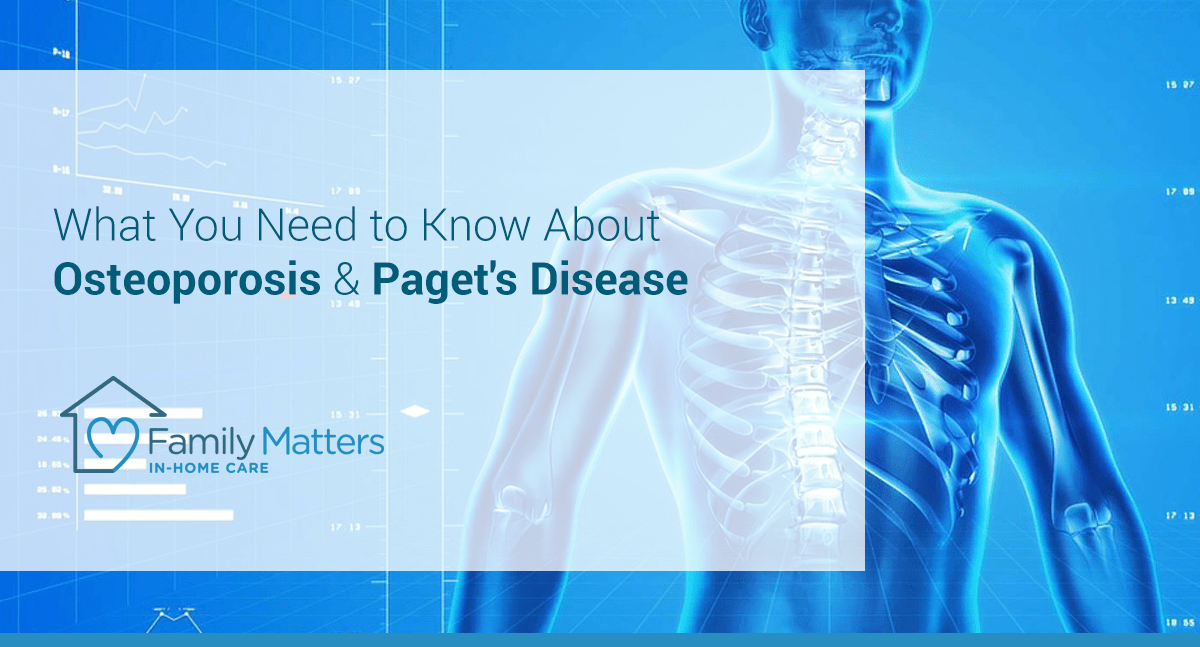 What You Need To Know About Osteoporosis & Paget’s Disease